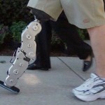 prothese bionique [1]